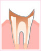 歯根まで進んだ虫歯（C4）